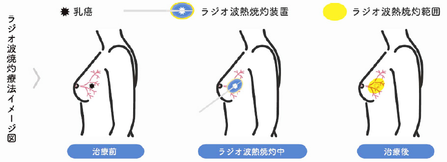 ラジオ波焼灼療法イメージ図