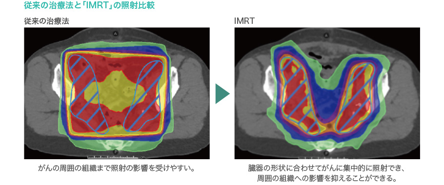 従来の治療法と「IMRT」の照射比較