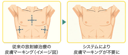 「皮膚マーキング」なしでの治療