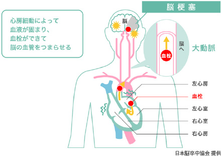 脳梗塞