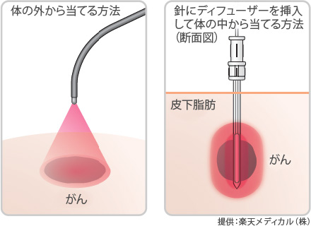 レーザー照射